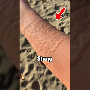 how to survive a jellyfish sting 😨