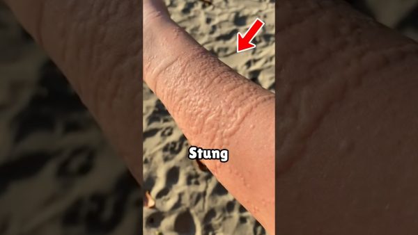 how to survive a jellyfish sting 😨